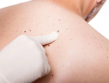 Πότε η φαγούρα σε ελιά είναι καρκίνος του δέρματος